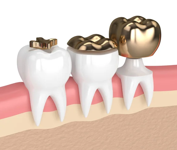 3d render of teeth with different types of dental gold filling — Stock Photo, Image