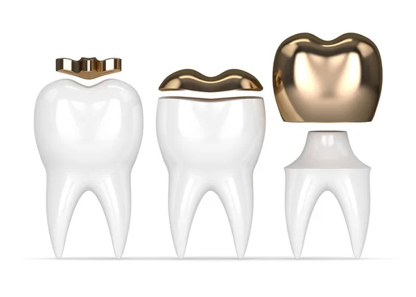 3d 不同类型牙齿金填充牙的呈现 — 图库照片