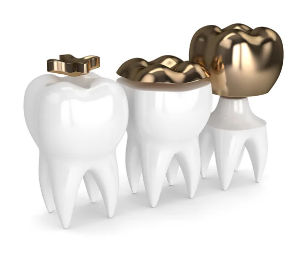 3d rendu des dents avec différents types de remplissage d'or dentaire — Photo