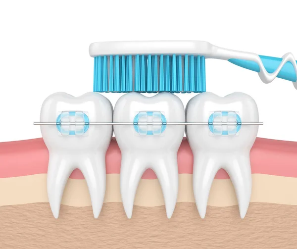 3D рендеринг зубов с брекетами и зубной щеткой — стоковое фото