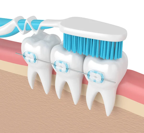 3d renderizado de dientes con frenos y cepillo de dientes — Foto de Stock