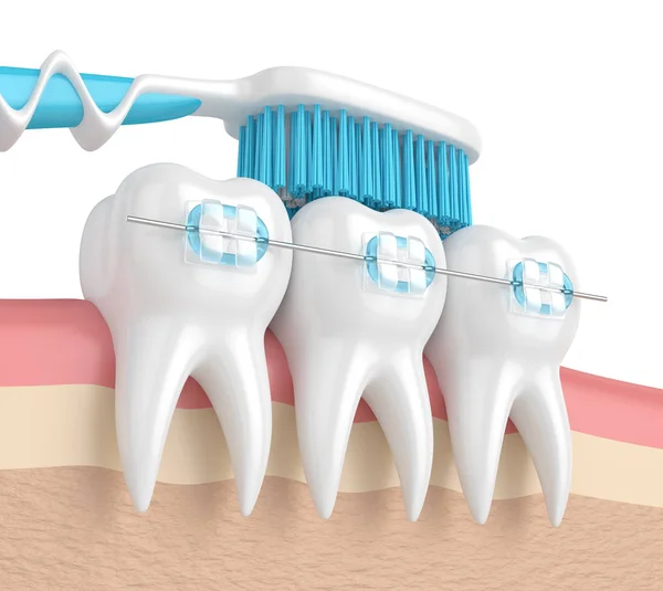 3d renderizado de dientes con frenos y cepillo de dientes — Foto de Stock