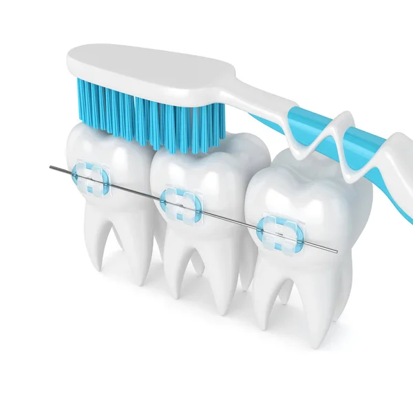 Odwzorowania 3D zębów z nawiasy klamrowe i szczoteczka do zębów — Zdjęcie stockowe