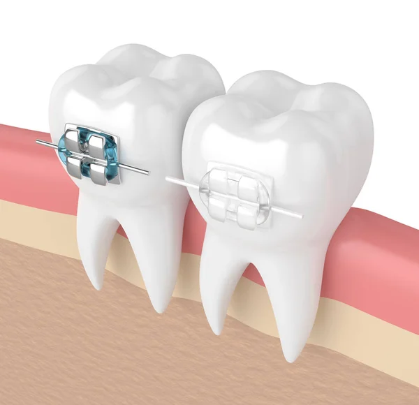 3D renderização de dentes com aparelho cerâmico e metálico — Fotografia de Stock