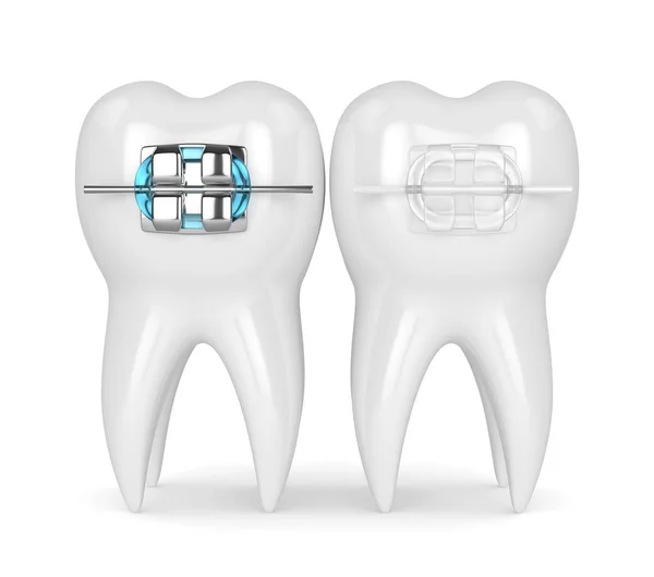 세라믹과 금속 교정기로 치아의 3d 렌더링 — 스톡 사진