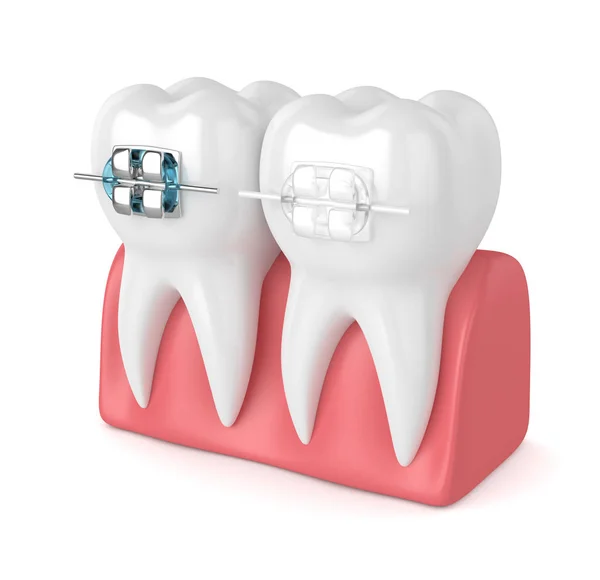 3d render of teeth with ceramic and metal braces — Stock Photo, Image