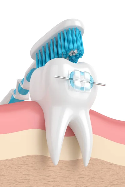 3D renderização de dente com aparelho e escova de dentes — Fotografia de Stock