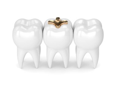 diş diş altın kakma dolgu ile 3D render