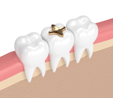 3d render of teeth with dental golden inlay filling clipart