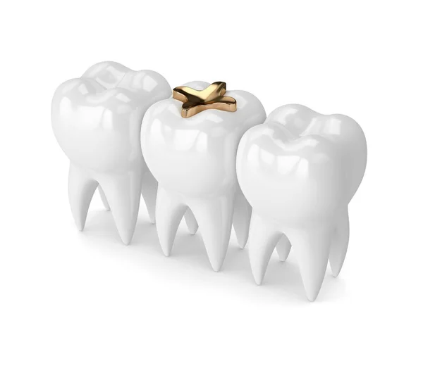 3d render of teeth with dental golden inlay filling