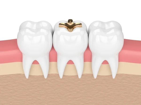 Rendering 3d dei denti con intarsio dentario dorato — Foto Stock