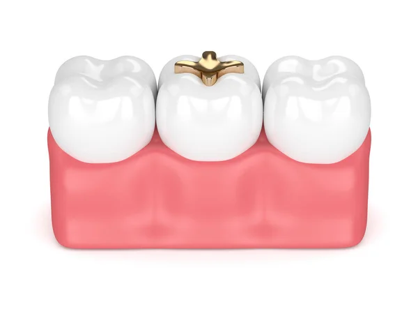3d визуализация зубов с зубной золотой инкрустацией — стоковое фото