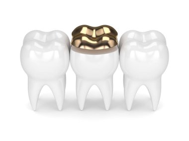 diş diş altın onlay dolgu ile 3D render