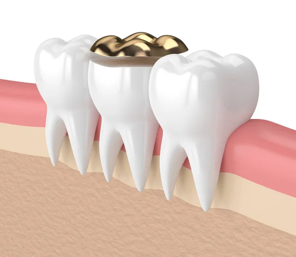 3d render of teeth with dental golden onlay filling — Stock Photo, Image