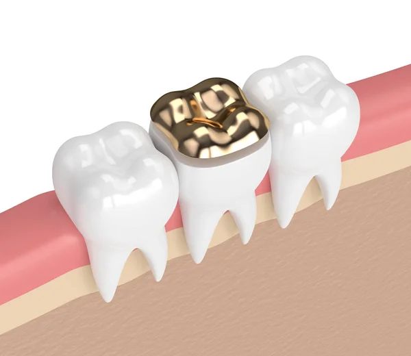 Diş diş altın onlay dolgu ile 3D render — Stok fotoğraf