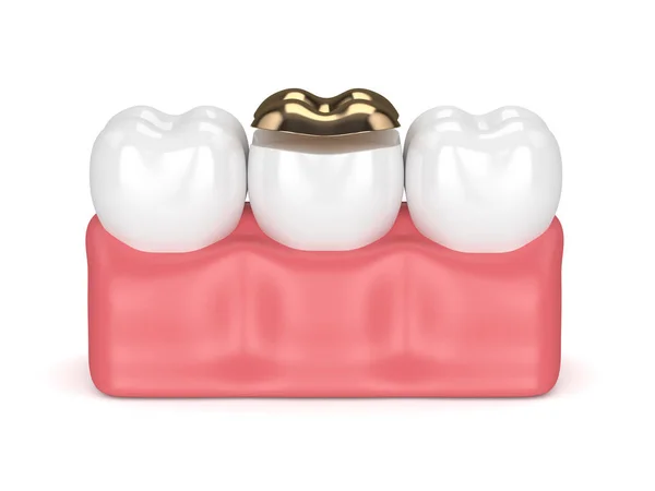 Rendering 3d dei denti con otturazione dentale dorata — Foto Stock