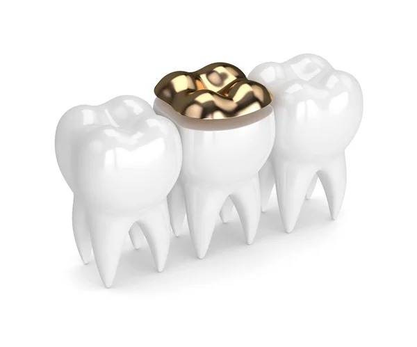 歯科黄金上張り充填歯の 3 d レンダリング — ストック写真