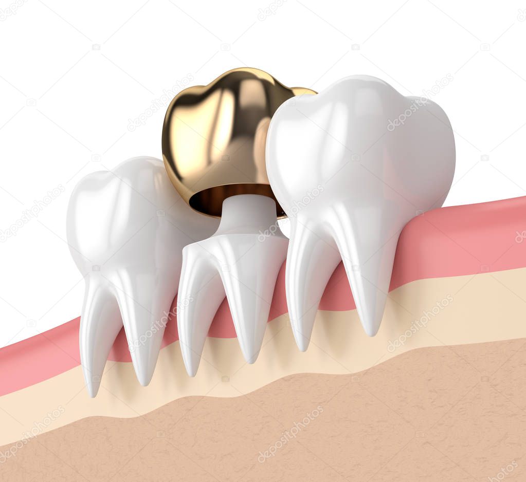 3d render of teeth with dental golden crown filling