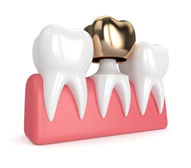 diş diş altın taç dolgu ile 3D render