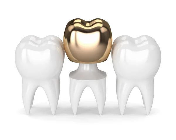 3d render of teeth with dental golden crown filling — Stock Photo, Image