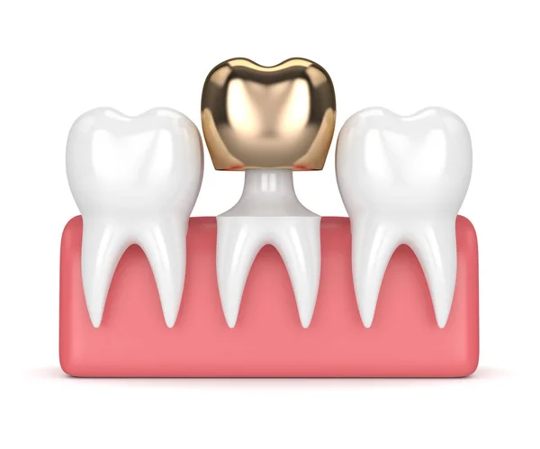 치과 황금 크라운 충전 물 가진 치아의 3d 렌더링 — 스톡 사진