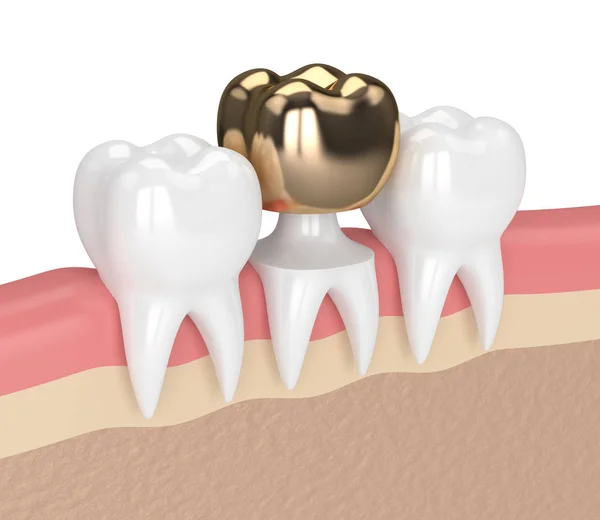 3d render of teeth with dental golden crown filling — Stock Photo, Image