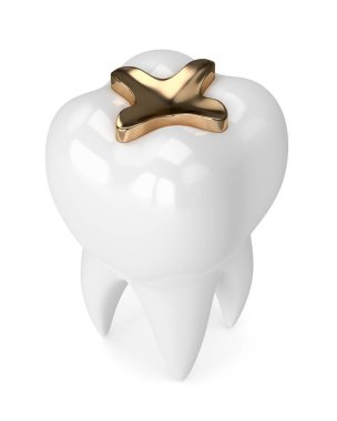 diş diş altın kakma dolgu ile 3D render