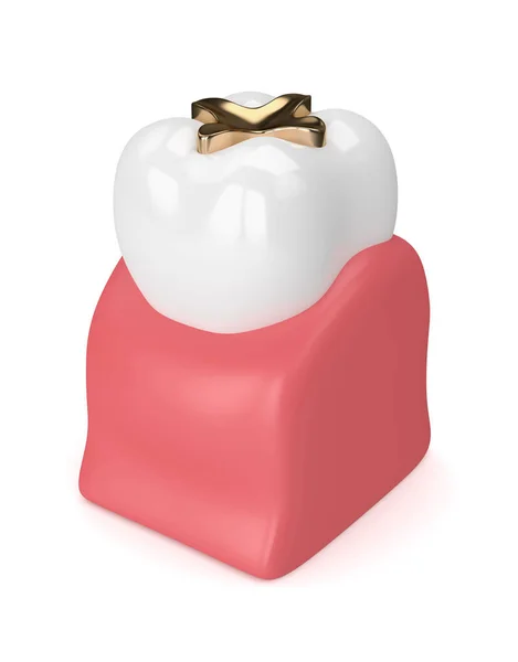 3d render of tooth with dental golden inlay filling — Stock Photo, Image
