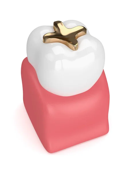 3d rendu de dent avec incrustation dorée dentaire remplissage — Photo
