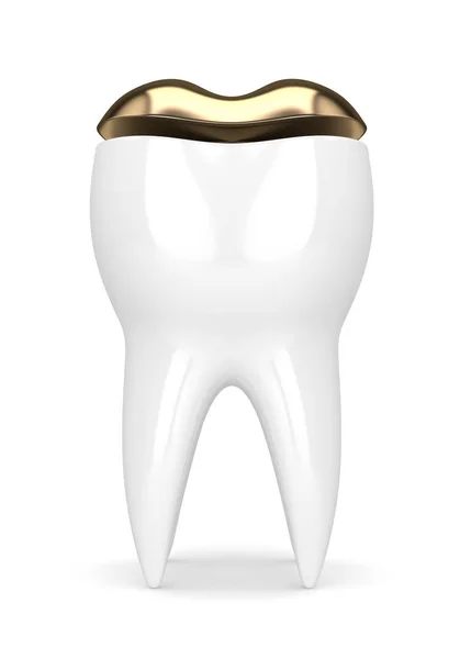 3D vykreslování zubu s náplní dentální zlaté onlay — Stock fotografie