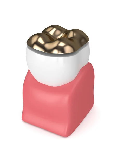 3d render of tooth with dental golden onlay filling — Stock Photo, Image