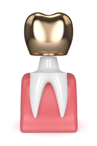 3D render av tand dental golden crown fyllning — Stockfoto