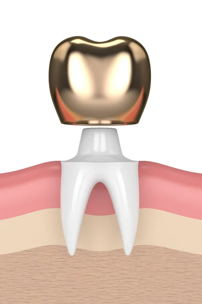 3d render of tooth with dental golden crown filling — Stock Photo, Image