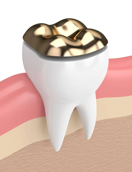 3d render of teeth with dental onlay filling — Stock Photo, Image