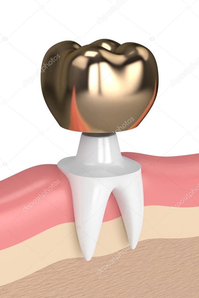 3d render of tooth with dental golden crown filling
