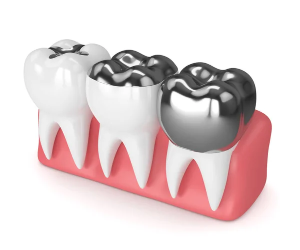 A fogak, a különböző típusú fogászati amalgám fillin 3D render — Stock Fotó