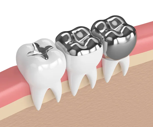 3d renderizado de dientes con diferentes tipos de relleno de amalgama dental — Foto de Stock