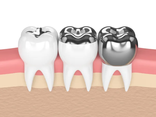 Rendement 3D de dents avec différents types de plombs d'amalgame dentaire — Photo