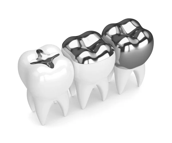 Rendering 3d di denti con diversi tipi di fillin di amalgama dentale — Foto Stock