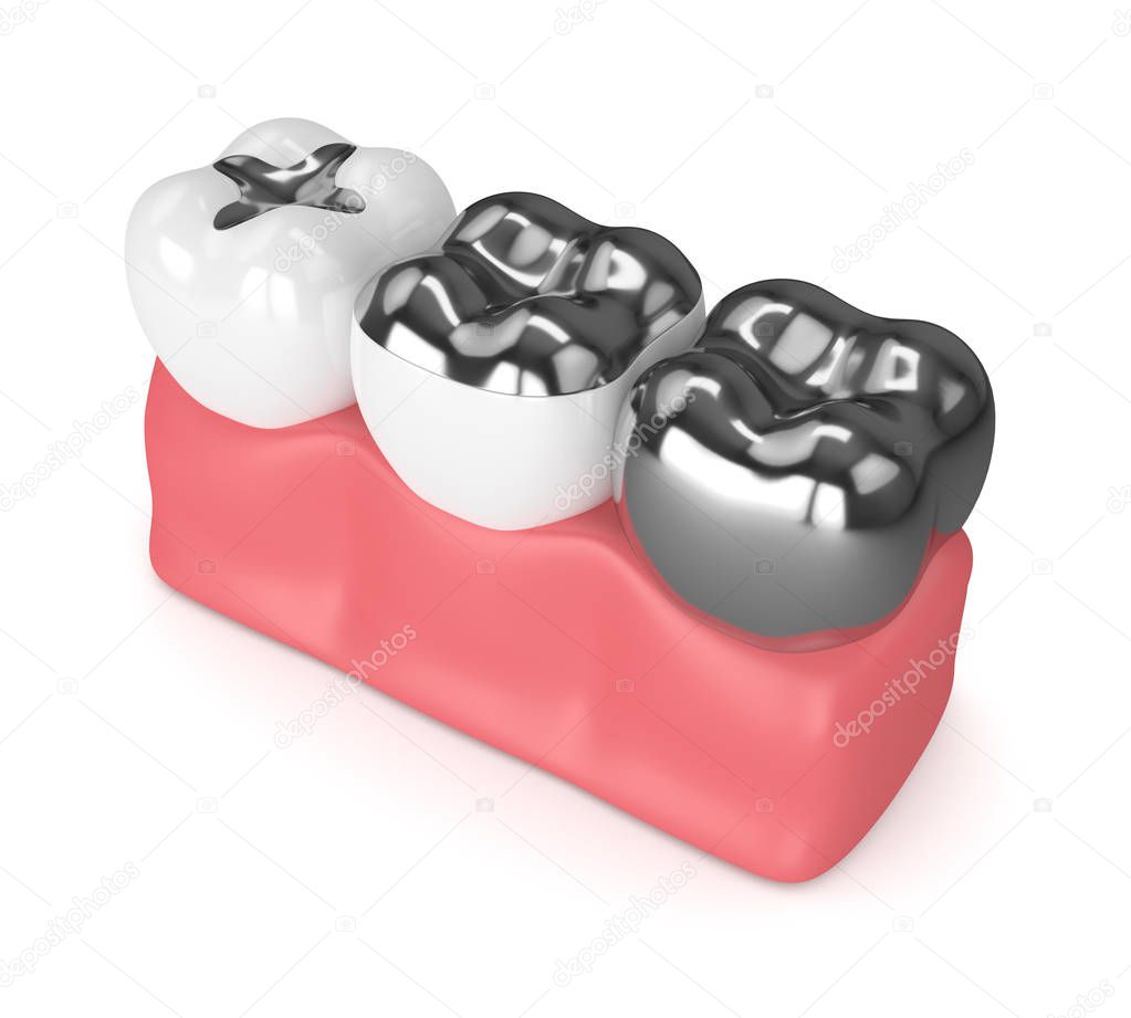 3d render of teeth with different types of dental amalgam fillin