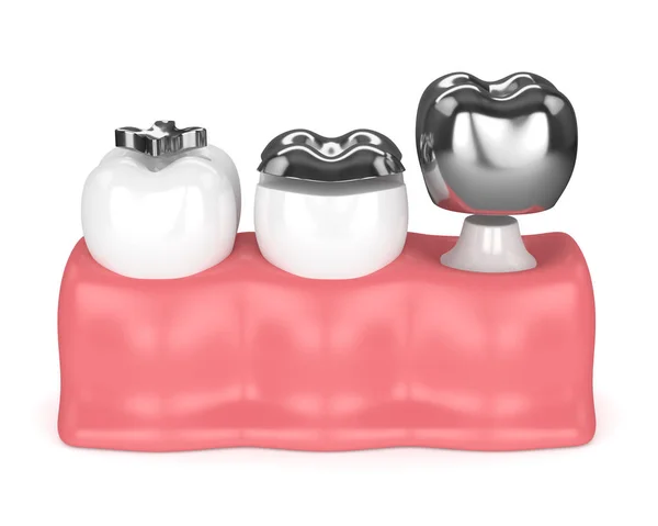 3D рендеринг зубов с различными типами зубной амальгамы наполнителя — стоковое фото
