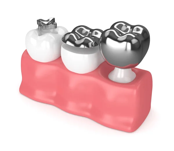 3d renderização de dentes com diferentes tipos de fillin amálgama dental — Fotografia de Stock