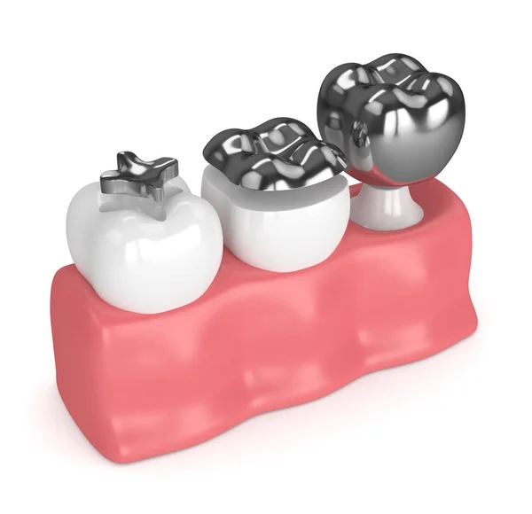 3d render of teeth with different types of dental amalgam fillin — Stock Photo, Image