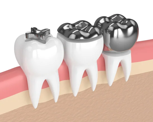 3d render of teeth with different types of dental amalgam fillin — Stock Photo, Image