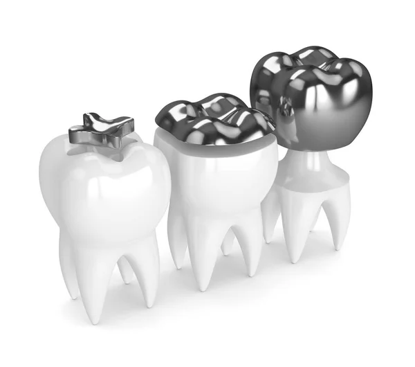 3d render of teeth with different types of dental amalgam fillin — Stock Photo, Image