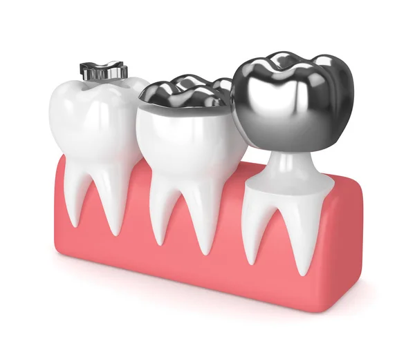 3d renderização de dentes com diferentes tipos de fillin amálgama dental — Fotografia de Stock