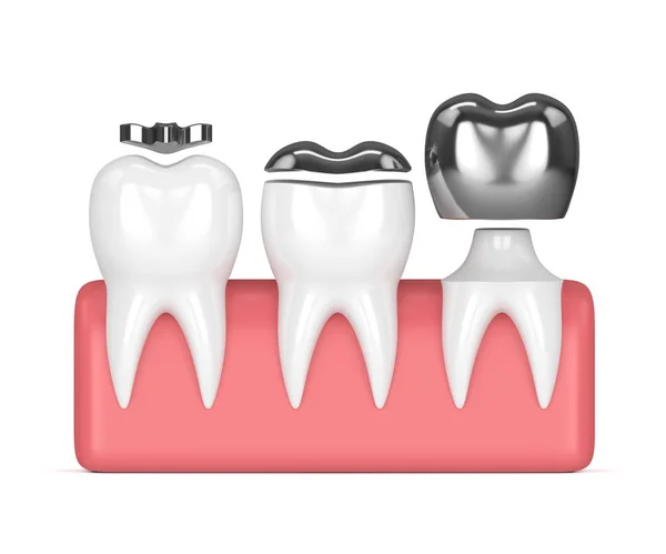 3d renderizado de dientes con diferentes tipos de relleno de amalgama dental — Foto de Stock