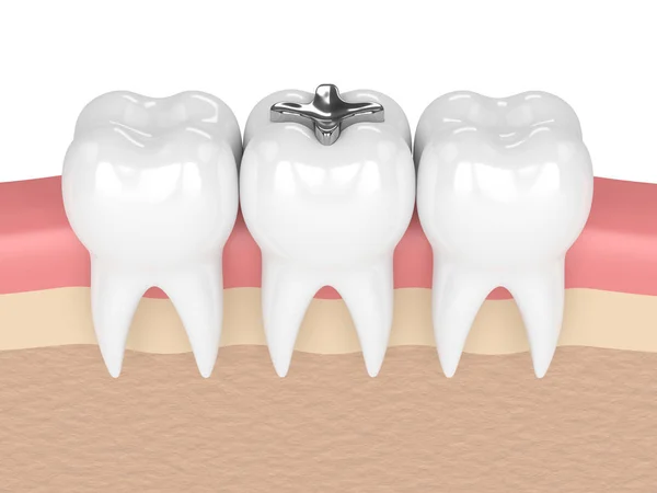 3d render of teeth with dental amalgam filling — Stock Photo, Image