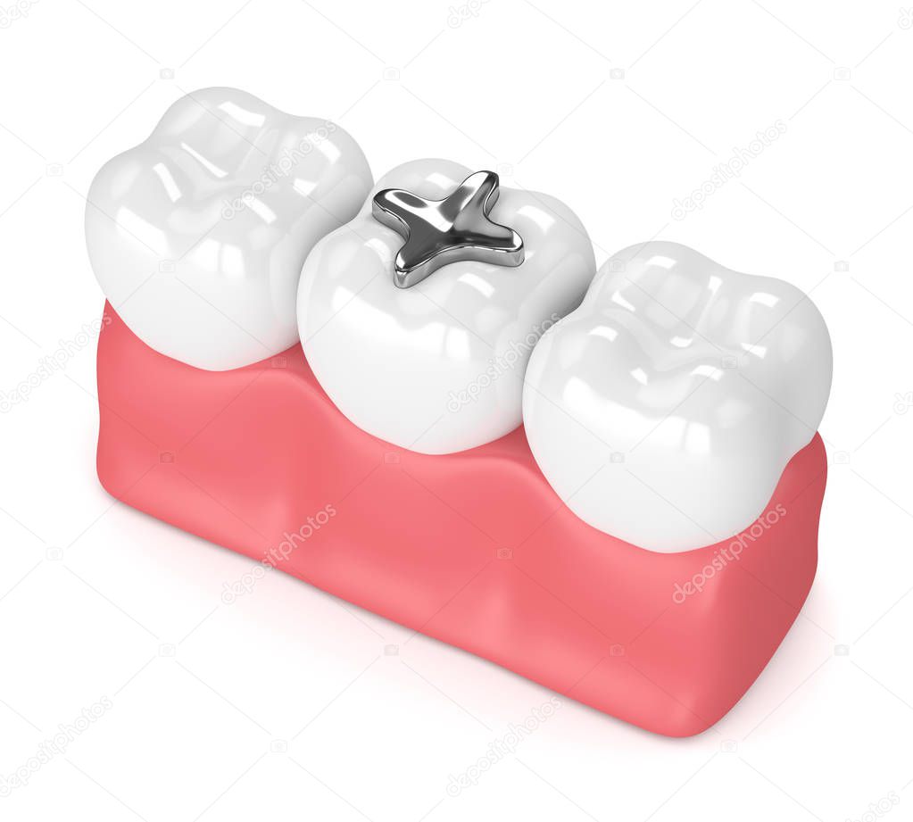 3d render of teeth with dental amalgam filling