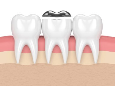 3d render of teeth with dental onlay amalgam filling clipart